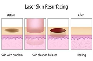 Laser Hair Reduction