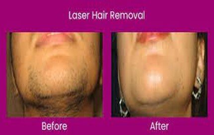 Laser Hair Reduction