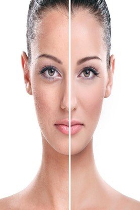 Melsama Laser Treatment