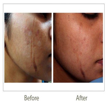 Fractional Laser