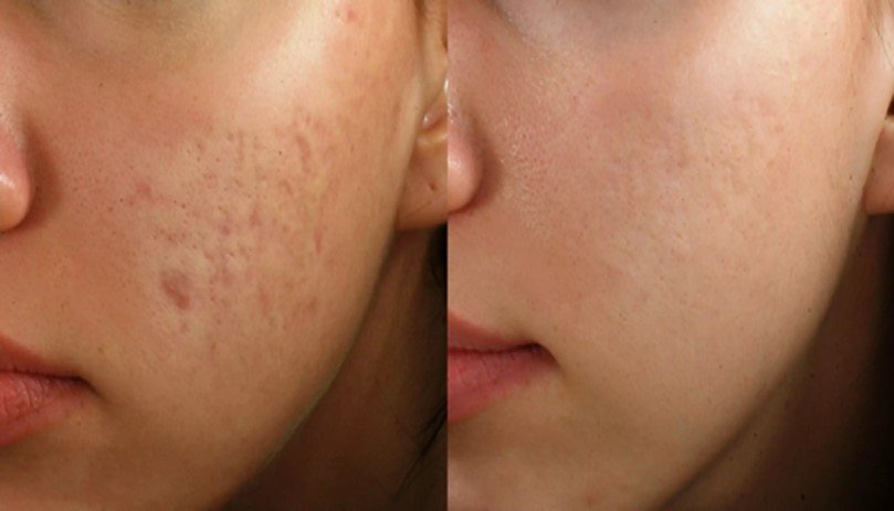 Laser Treatment for acne