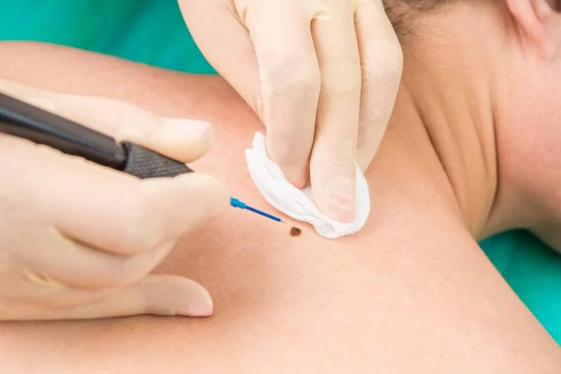 Warts And Moles Removal