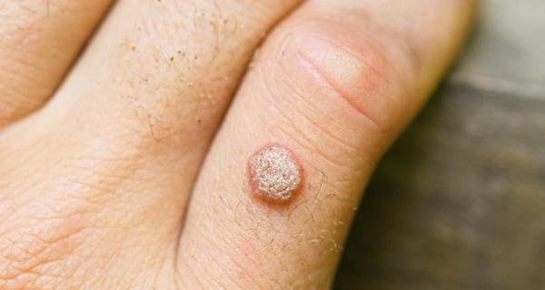 wart in hand