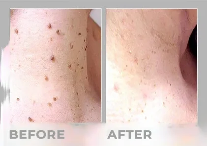 Electrosurgery Skin Tag Removal
