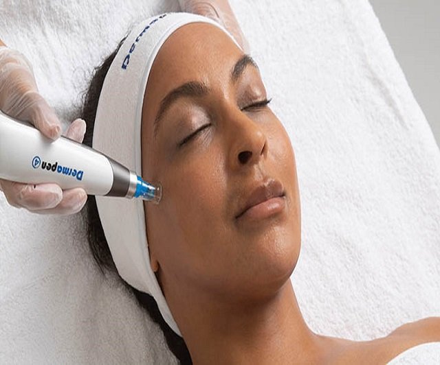 RADIOFREQUENCY MICRONEEDLING