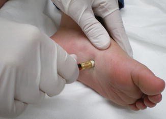 Skin Biopsy-Diagnostic Services