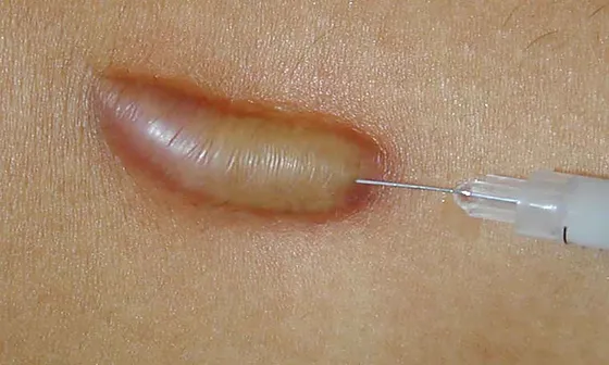 Intralesional Injections