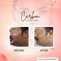 Before and After Carbon Peel