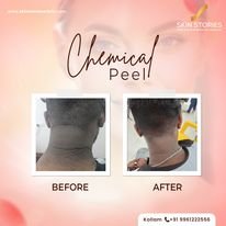 Before and After Chemical Peel