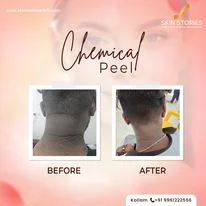 Before and After Chemical Peel