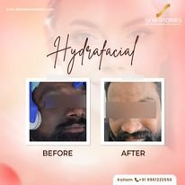 Before and After Hydra Facial