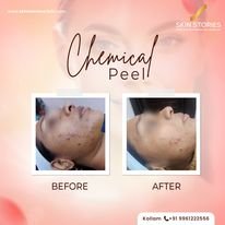 Before and After Chemical Peel
