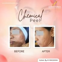 Before and After Chemical Peel