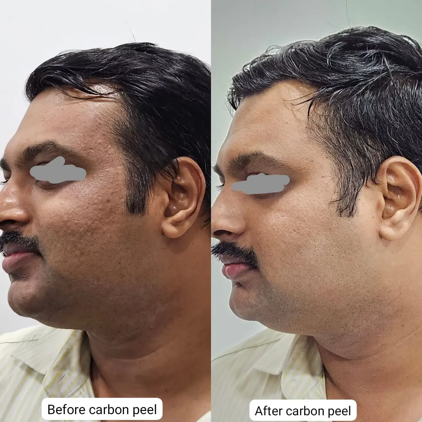 before and after carbon laser peel