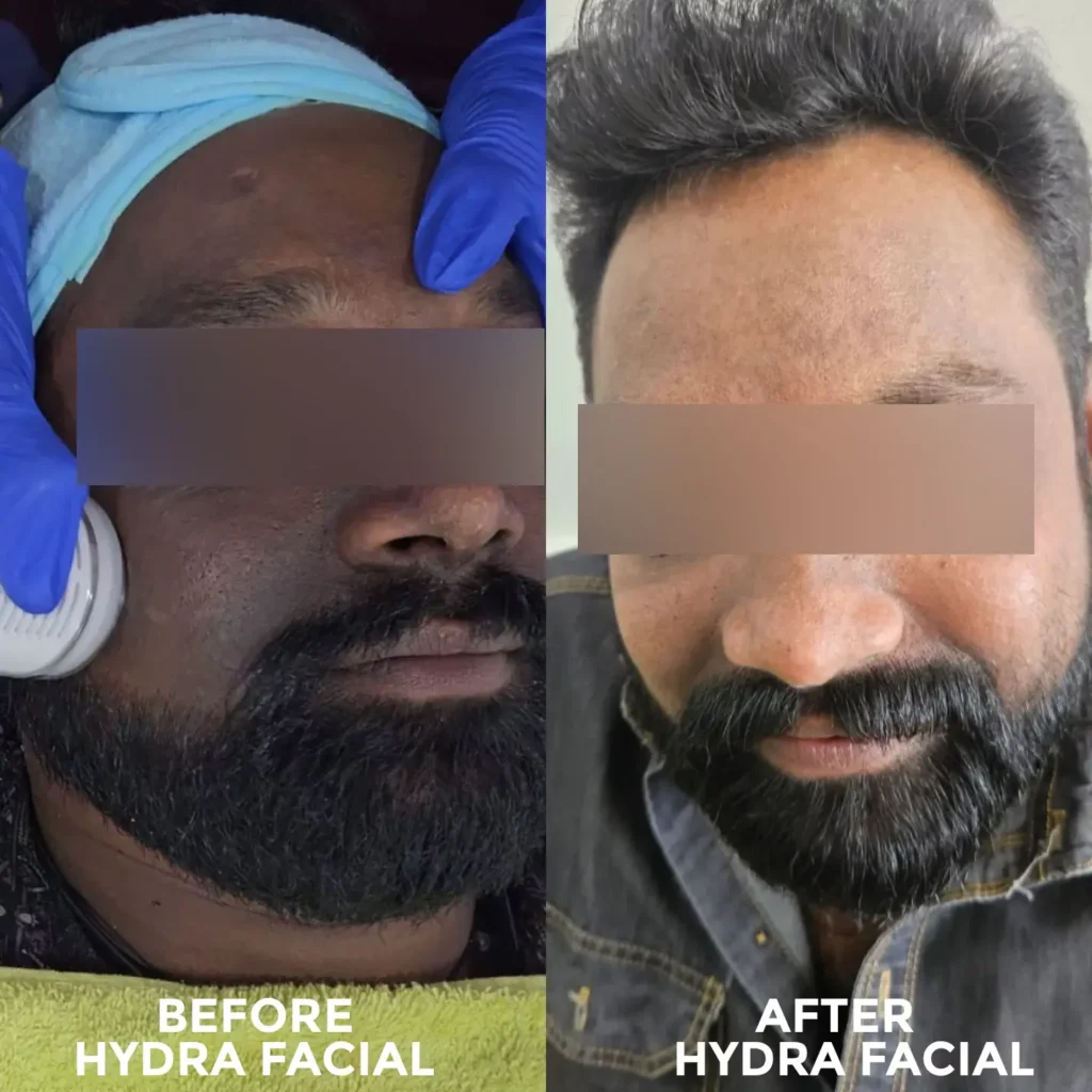 before and after hydra facial