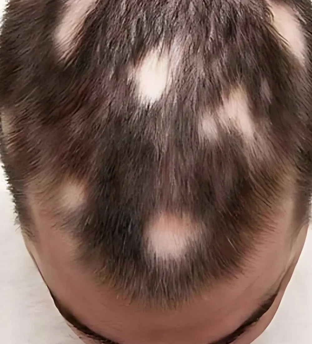 Alopecia areata Treatment