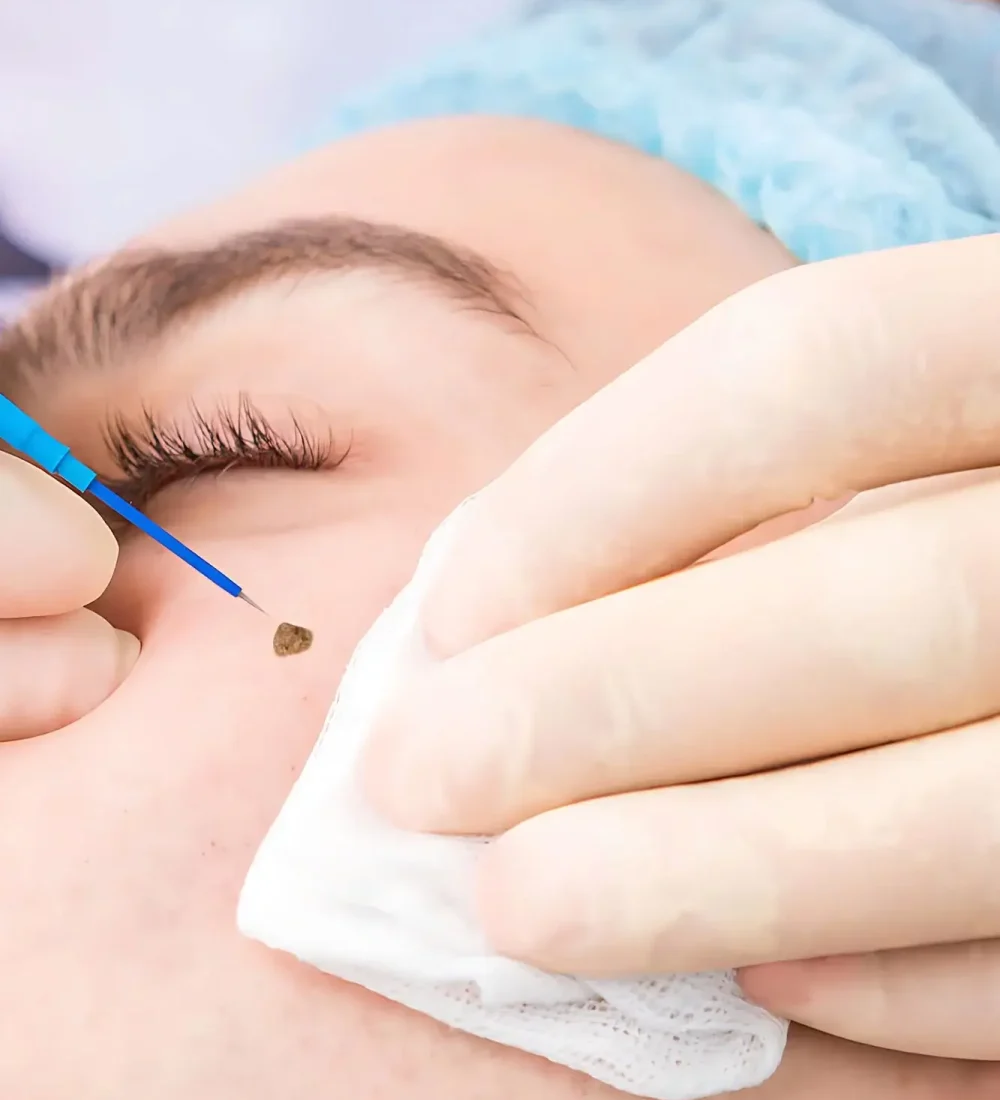 Electrosurgery Skin Tag Removal 125KB