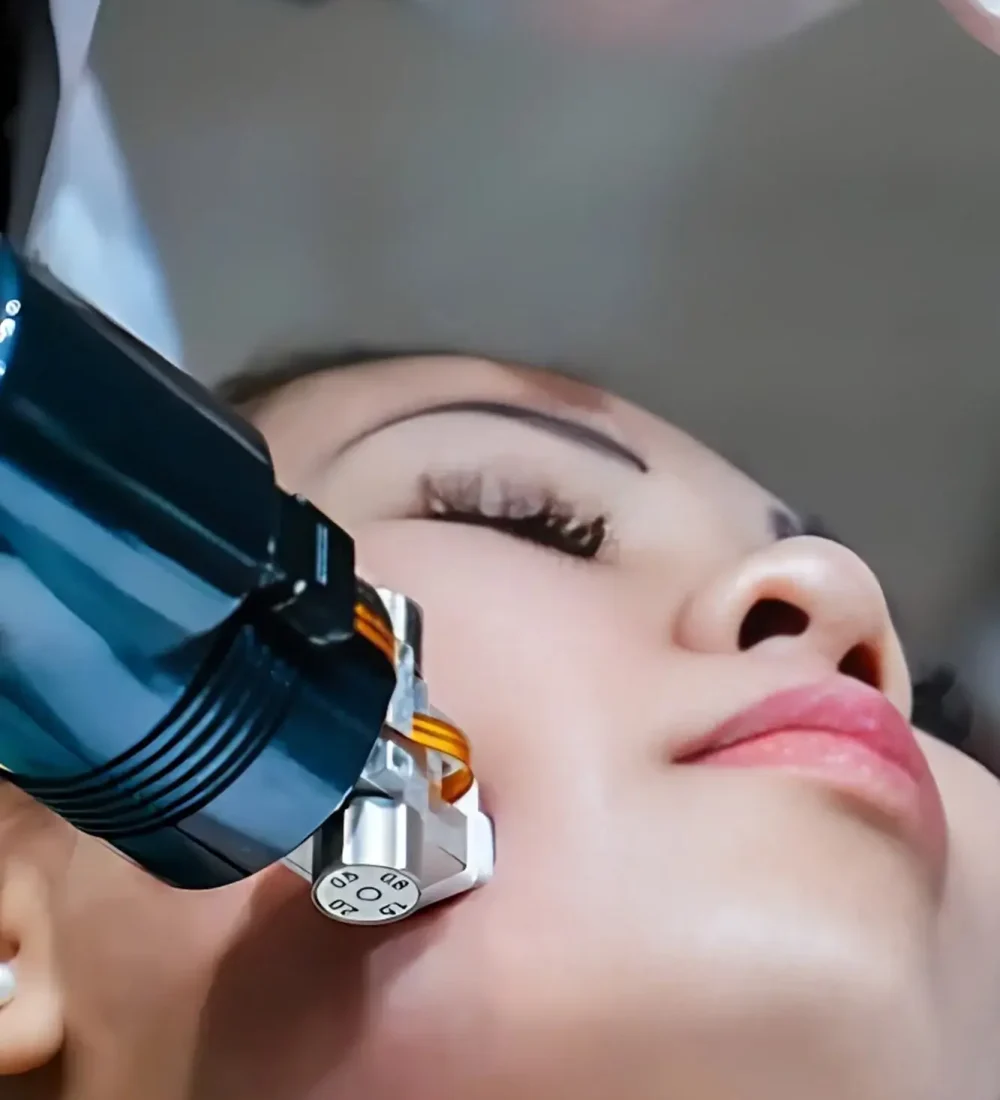 RADIOFREQUENCY MICRONEEDLING 138KB