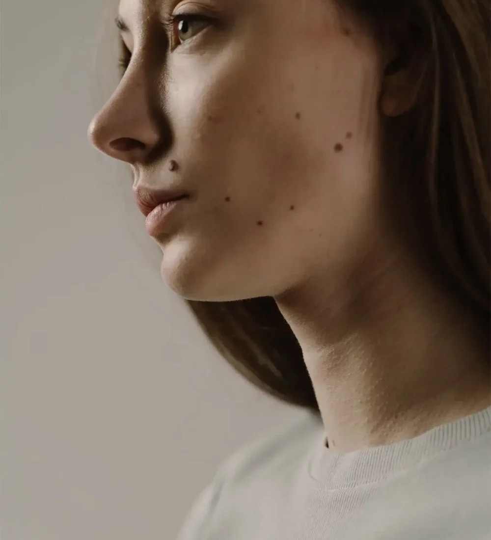 WARTS AND MOLES REMOVAL Skin & Hair Treatments